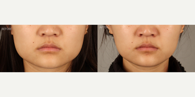 Non-Surgical Facial Slimming - 26-year-old female with a history of a widened, square jaw secondary to severe grinding and clenching causing masseter muscle enlargement. She is shown six weeks after targeted Botox injections to gently weaken and shrink the masseter muscles, and narrow the hawline. The patient also reported significant relief of her temporomandibular joint (TMJ) pain, which is a common additional result of this treatment.