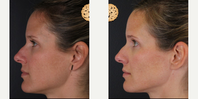 35-44 year old woman treated with Dermalinfusion - Dermal Infusion - Before & After