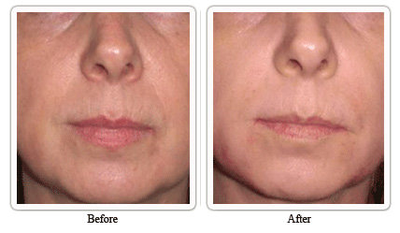 Evolence: a naturally younger-looking you - 	This photo was taken immediately before and after treatment of smile folds with Evolence.