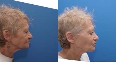 65-74 year old woman treated with Morpheus8 - Female patient treated with Morpheus8 for deep lines, wrinkles, lip lines, loose skin