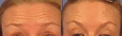 45-54 year old woman treated with Botox - Botox treatment performed by Dr. Bryson Richards