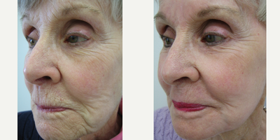 75 and up year old woman treated with Chemical Peel - Customized Chemical Peel