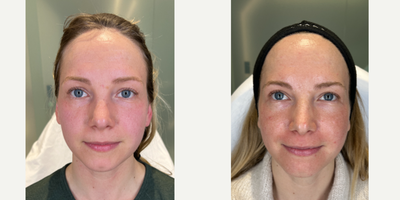 SMOOTH SKIN IS IN | ACNE SCAR COMBINATION - Our patient has been battling acne scars since her teenage years, with a few pesky crater and ice-pick scars lingering on her cheeks and some deeper ones on her temples 