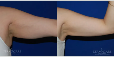Woman treated with Tickle Lipo - Woman treated with Tickle Lipo