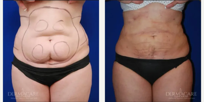 Woman treated with Tickle Lipo - Woman treated with Tickle Lipo