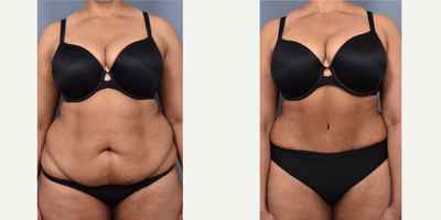 35-44 year old woman treated with Tummy Tuck - Tummy Tuck with Liposuction
