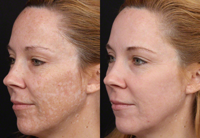 Cosmelan for Melasma Post-Pregnancy - Patient was treated with Cosmelan MD (Hydroquinone) to help lighten the melasma she developed after pregnancy.