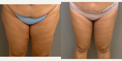 45-54 year old woman treated with Liposuction, SAFELipo, Tumescent Liposuction - 51 yo woman with liposuction to the inner and outer thighs performed under local anesthesia with sedation in our on site AAA certified operating suite.