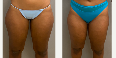 25-34 year old woman treated with Liposuction, SAFELipo, Tumescent Liposuction - 30 yo woman s/p liposuction to outer thighs performed under local anesthesia with sedation in our on site AAA certified operating suite.