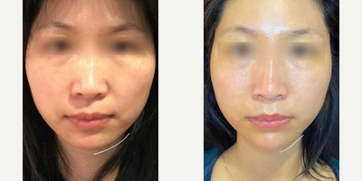 Woman treated with Sofwave - Woman treated with Sofwave to firm and tighten skin