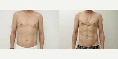 57 years old male treated with Abdominal Etching - The patient was doing body weight lifting for 6 years but couldn't get a proper sixpack. This is 3 months after surgery. He has good skin tightness