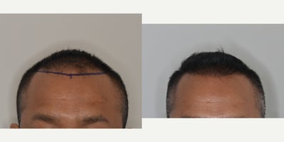 35-44 year old man treated with FUE Hair Transplant - Before and after 1300 FUE grafts to reinforce and lower hairline in a 42 year old male