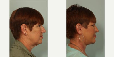 45-54 year old woman treated with Facelift - Glidelift, neck lift and fat transfer to face; 6 months post-op