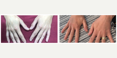 45-54 year old woman treated with Radiesse - Radiesse in hands