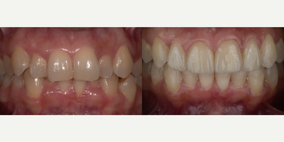 35-44 year old woman treated with Zoom Whitening, Invisalign and Veneers - Invisalign, bleaching, and four porcelain veneers that grace the front teeth. Proof that minimalism can redefine beauty. When teeth find their perfect alignment, aesthetics effortlessly intertwine with functionality.