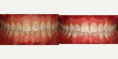 25-34 year old man treated with Zoom Whitening - This patient desired whiter teeth. Zoom Teeth Whitening was used to achieve brighter, whiter teeth. Patient was very happy with results.