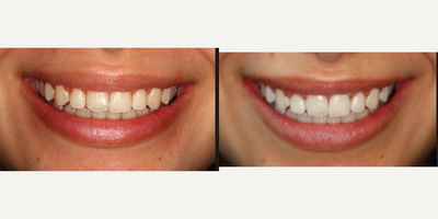 25-34 year old woman treated with Zoom Whitening - This patient desired whiter teeth. Zoom Teeth Whitening was used to achieve brighter, whiter teeth. Patient was very happy with results.