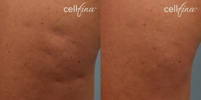 35-44 year old woman treated with Cellfina - 36-year-old female patient treated for cellulite on thighs.
