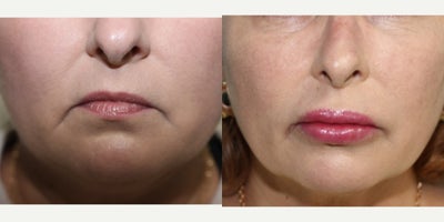 45-54 year old woman treated with Silikon 1000 - This patient was looking to enhance her lips with a more natural, subtle pout with our permanent lip filler silikon 1000.
