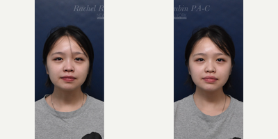 18-24 year old woman treated with Dermal Fillers, Restylane, Voluma, Juvederm, Restylane Lyft - Woman in her 20s: Chin filler for length, projection, and overall more feminine face shape. Botox lip flip to evert upper lip.