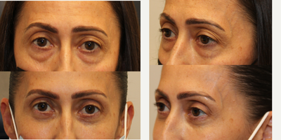 Lower blepharoplasty with fat grafting and skin peel - This woman had transconjunctival eye bag removal followed by fat grafting to the under eyes/cheeks and chemical skin peel to the lower eyelid skin