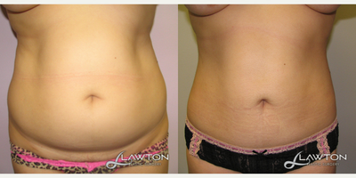 35-44 year old woman treated with Liposculpture - 6 months after liposuction
