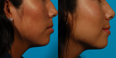 25-34 year old woman treated with Revision Rhinoplasty - Young woman with a previous rhinoplasty was unhappy with her results. The doctor recommended a revision rhinoplasty. She was able to see the outcome when he used the digital imager, giving her a glimpse of the result they could achieve with the revision rhinoplasty.