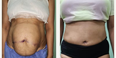 25-34 year old woman treated with Tummy Tuck, Diastasis Recti Repair - 26 year old woman who  Tummy tuck and diastasis Recti repair