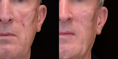 65-74 year old male scar removal with excision followed by dermabrasion and DeepFX laser resurfacing - Excision, Dermabrasion, DeepFX scar resurfacing