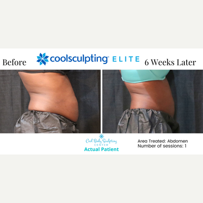 35-44 year old woman treated with CoolSculpting Elite - CoolSculpting results