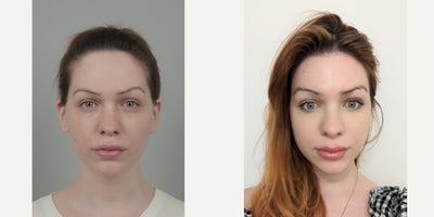 25-34 year old woman treated with AccuLift, Cheekbone Reduction, Contour Thread Lift, Facial Fat Transfer, Forehead Reduction, M - .