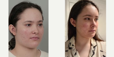 18-24 year old woman treated with AccuLift, Cheekbone Reduction, Facial Fat Transfer, Forehead Reduction, Nonsurgical Facelift,  - .