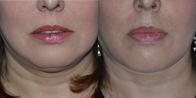 25-34 year old woman treated with Lipodissolve - Before and after Kybella injection for double chin.