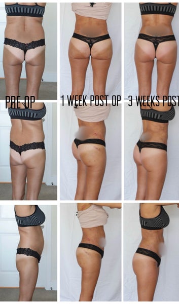 Petite Skinny Bbl 5 1 105lbs Review Realself