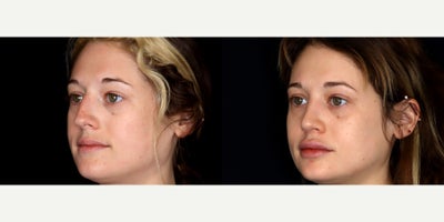29 year old woman treated with Rhinoplasty, Voluma, Juvederm - 29 year old woman treated with rhinoplasty, 1 syringe of Voluma to cheeks, 1.5 syringe of Juvederm Ultra CX to lips and 0.5 syringe of Juvederm Ultra XC to nasalabial folds. Photos depict before and 3 months after treatment.