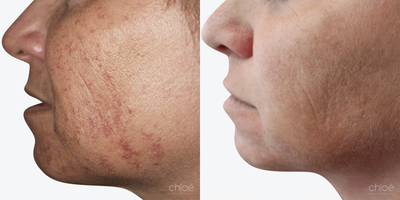 Face Age Spots Treatment using Chemical Peel - Solar lentigos, commonly called dark spots or age spots, are flat brown spots caused by sun exposure. They may be present all over the body surface, especially in the areas most exposed to UV rays. This condition can be effectively treated with chemical peels.
