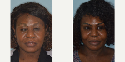 35-44 year old woman treated with African American Rhinoplasty - Challenging case of a female patient with very thick nasal skin who desired refinements to the nose. Her rhinoplasty techniques included an open approach, nasal skin de-fatting, radix graft, bilateral osteotomies, caudal septal extension graft for tip support, tip onlay grafts, and alar base reductions.
