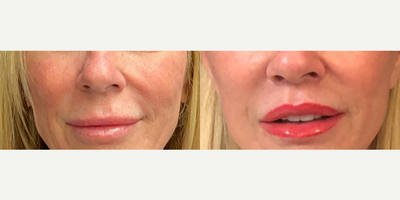Woman treated with Lip Lift - Lip Lift 20mm to 13mmLip lift or just overdrawn lipstick?! Lip lift! You can get tooth show without excising lip skin. Her lips look plump and her mouth has a youthful sexiness too it. The best part is you cant even see her incision!