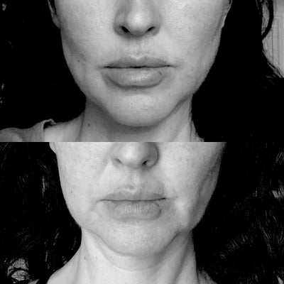 BOTOX® for Masseter & Jaw Before & After Photo Gallery, San Francisco, CA