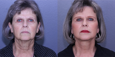 55-64 year old woman treated with Lifestyle Lift - Lifestyle Lift and fat Transfer