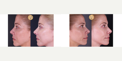 35-44 year old woman treated with Vivace - Vivace creates clearer skin with improved texture and reduced scarring.