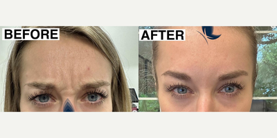 Woman treated with Botox - Woman treated with Botox