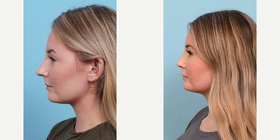 18-24 year old woman treated with Rhinoplasty - This patient says she has difficulty breathing due to a deviated septum. The doctor preformed an external primary rhinoplasty with septoplasty 1 month ago. Her swelling will continue to subside over the next year.