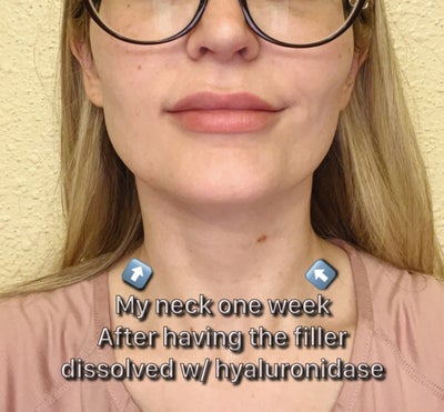 Filler disaster - it made my neck look older and disfigured - Filler disaster - it made my neck look older and disfigured -
