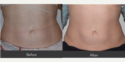 45-54 year old woman treated with Aquagold and DermaPen with PRP - Our 52 yr. old pt. wanted to focus on thickening her skin without the use of fillers or lasers. She had 4 treatments using Aquagold with PRP to her hands and 3 treatments using a combination of Aquagold and DermaPen with PRP to her abdomen. Treatments were done 4-6 weeks apart. Her veins are no longer available, her abdomen is noticeably tighter, and belly button is higher. *Great option for someone with very thin skin who is hesitant about the use of fillers. Through the use of ultrasound technology and taking dermal measurements each visit, we have data proving that her overall skin thickness increased after each session