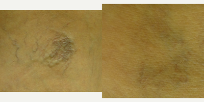 35-44 year old woman treated with Sclerotherapy - 38 year old female before and after 4 laser vein removal treatments. Notice on the closeup pictures the improvement in both varicose veins and spider veins. Patient was happy with the result. She can continue a laser treatment every 4-6 weeks to continue vein clearance.