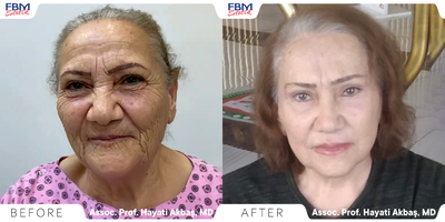 55-64 year old woman treated with Deep Plane Facelift, Double Eyelid Surgery, Neck Lift, Facial Fat Transfer, Brow Lift - 64 years old woman treated with Deep plane facelift, neck lift, eyelids surgery, brow lift, and facial fat transfer. all applied in the same operation. 4 months post-operation the patient sent her photo and the recovery process will continue for one year.