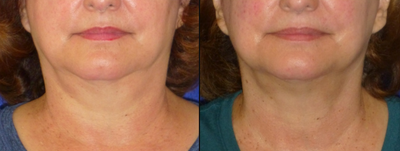 75 and up year old woman treated with CoolMini - Fat reduction and skin tightening at the neck and chin areas.
