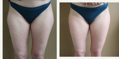 35-44 year old woman treated with Liposculpture - 35-44 year old woman treated with Liposculpture for correction of saddle bags, shown 6 months post op.