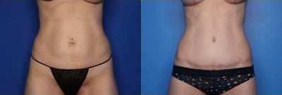 41 year old woman treated with Tummy Tuck, Liposuction - 41 year old woman treated with Tummy Tuck, Liposuction